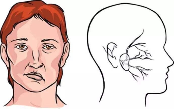 上海健橋醫(yī)院好不好，面癱的兩種常見癥狀和治療方法