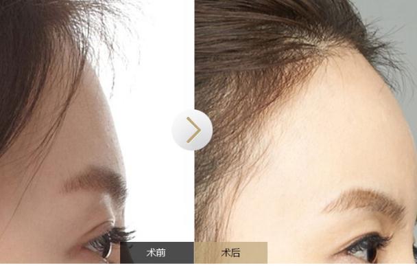 醫(yī)美緩解頸紋用哪種填充類？醫(yī)美打造澎潤額頭用什么填充?