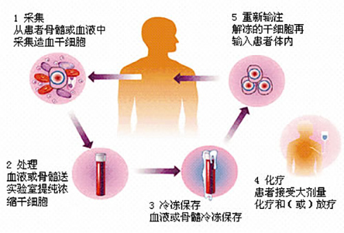 濟南血液病醫(yī)院科普：確診淋巴瘤，患者為何要接受造血干細胞移植？