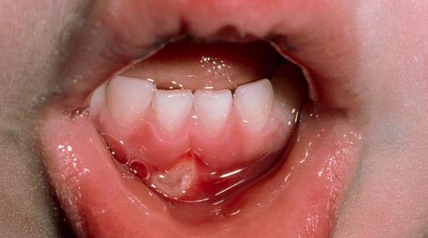 季節(jié)性口腔潰瘍是缺鋅嗎 口瘡,口腔黏膜病變