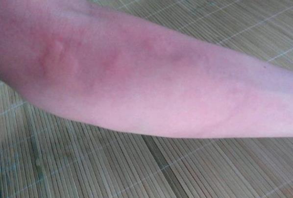 蕁麻疹長臉上會毀容嗎 護理得當發(fā)病后24小時內消退