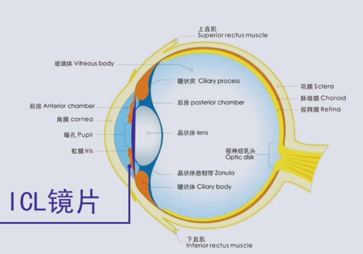  ICL晶體植入術(shù)貴在哪里？合肥普瑞眼科專家來解答（近視手術(shù)鉅惠來襲）