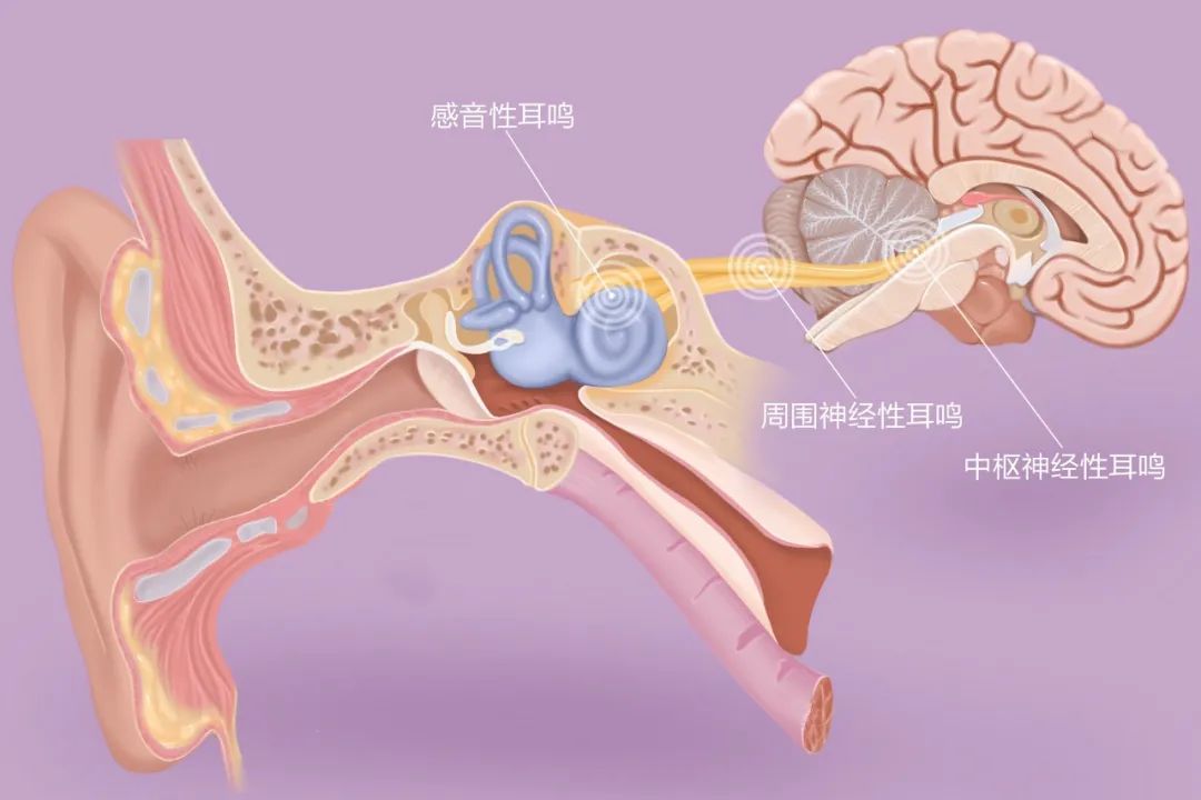 “嚶嚶嚶…”，成都民生耳鼻喉醫(yī)院提醒：耳鳴是身體的警報，須重視！