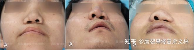 余文林健康科普：鼻假體的效果能維持多久？