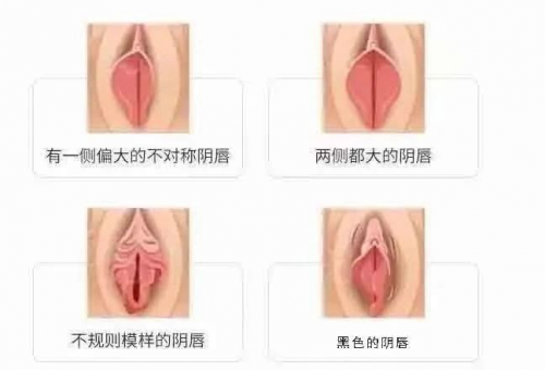 南寧南國做小陰唇肥大怎么樣？