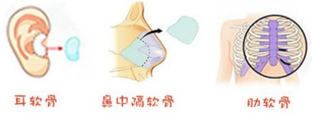 余文林唇裂修復(fù)團(tuán)隊(duì)：耳軟骨和肋軟骨哪個做修復(fù)更好？