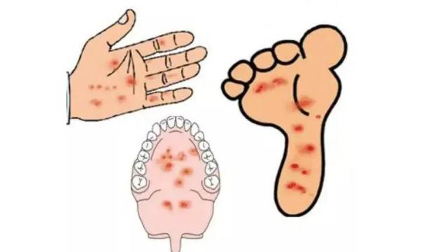 兒童手足口病皮疹需注意哪些？手足口病手上泡抓爛了怎么辦？