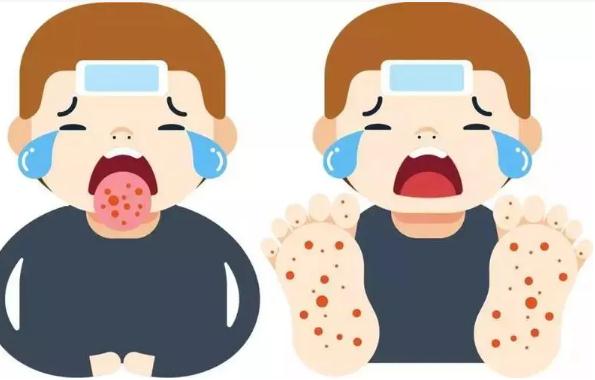 手足口病反復(fù)發(fā)燒怎么辦？手足口病洗澡有哪些注意事項？