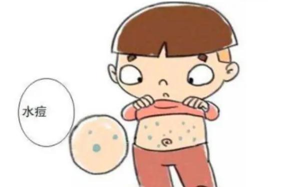 水痘怎樣好得快？出水痘有什么先兆癥狀嗎？