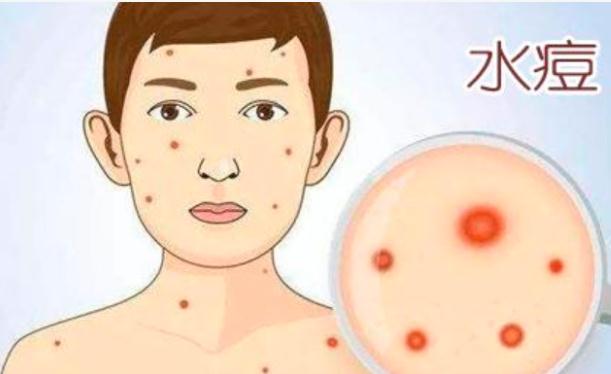 水痘如何治療？水痘是怎么引起的？
