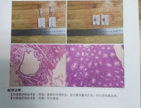 廣州東大肛腸醫(yī)院好不好34歲女士腸息肉切除后3年不查，拖出腸癌