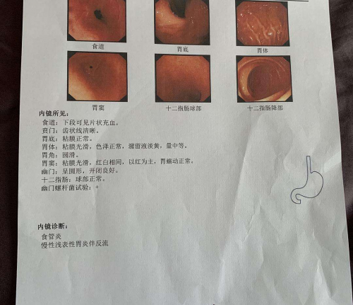 廣州東大肛腸醫(yī)院正規(guī)分析慢性淺表性胃炎是應(yīng)該需要治療嗎？