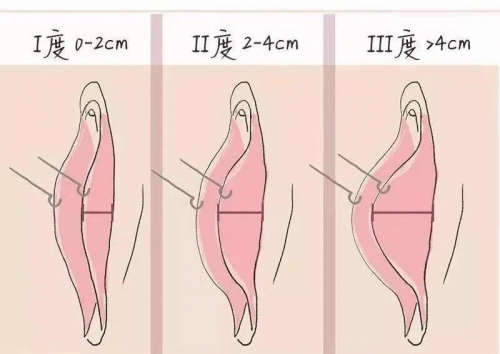 陰唇肥大又看不見，手術還有必要做嗎？在昆明這里告訴你!
