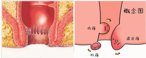 廣州東大肛醫(yī)院這樣區(qū)分內(nèi)痔外痔混合痔可信嗎？