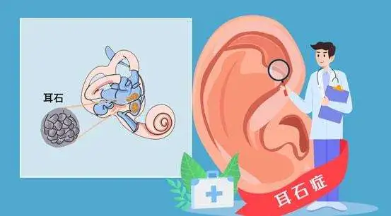 頭暈惡心，天旋地轉…耳朵里有“石頭”？成都民生耳鼻喉醫(yī)院：有這些癥狀要注意