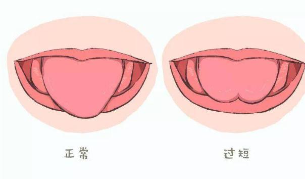 口吃與舌頭有關系嗎？口吃會遺傳給孩子嗎？