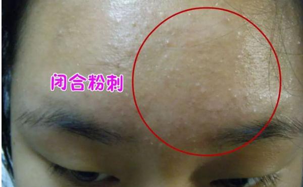 粉刺會(huì)變成痘痘嗎？痘痘擠出來的白色東西是什么？