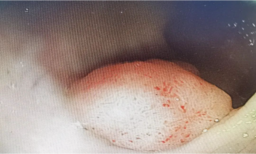 北京豐益肛腸醫(yī)院 再突破！我院內(nèi)鏡粘膜下剝離術(shù)(ESD)完整切除3.5*2.0cm腸道早期癌