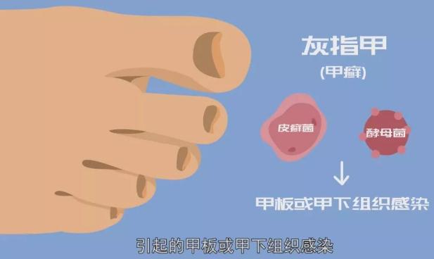 灰指甲怎么形成的？灰指甲可以做美甲嗎？