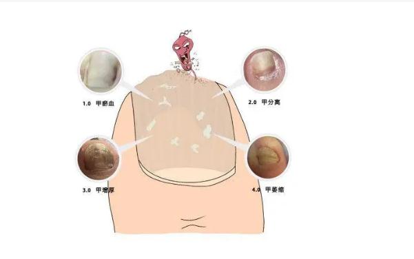 灰指甲會傳染給別人嗎？得了灰指甲怎么辦？