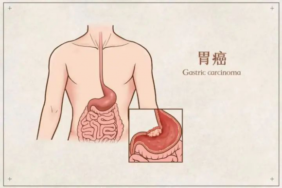 貴陽微創(chuàng)胃腸?？漆t(yī)院：注意！無癥狀也可能查出胃癌！這5類人必須盡早做胃鏡！