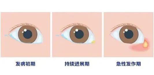 【合肥愛(ài)爾】女孩流淚8年？！原來(lái)是淚道堵塞！