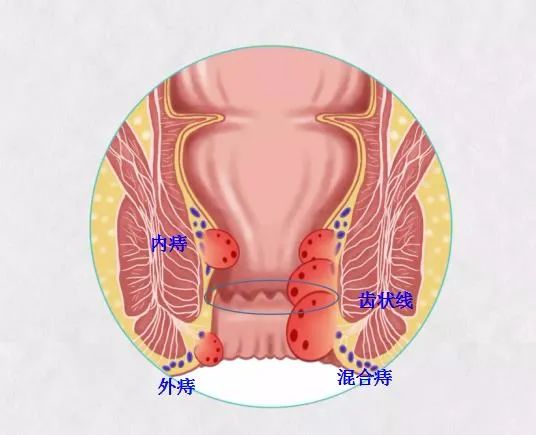 痔瘡之痛何以解，揚州妙手肛腸醫(yī)院為痔瘡病友解決“難言之苦”