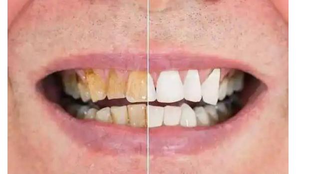 牙齒有黃斑怎么去除呢？如何避免洗牙時(shí)牙齒疼痛？