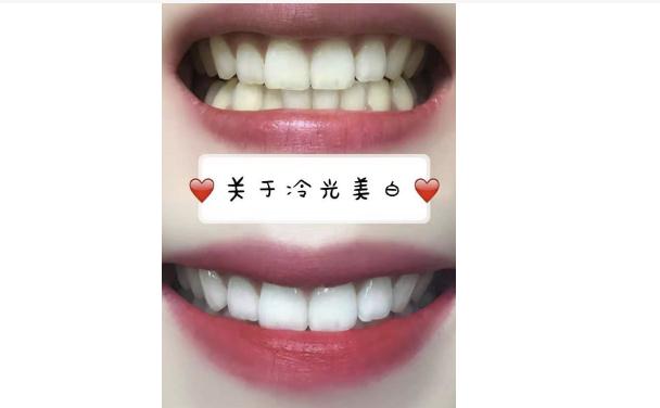 冷光美白牙齒的原理是什么呢？冷光美白牙齒有副作用嗎？