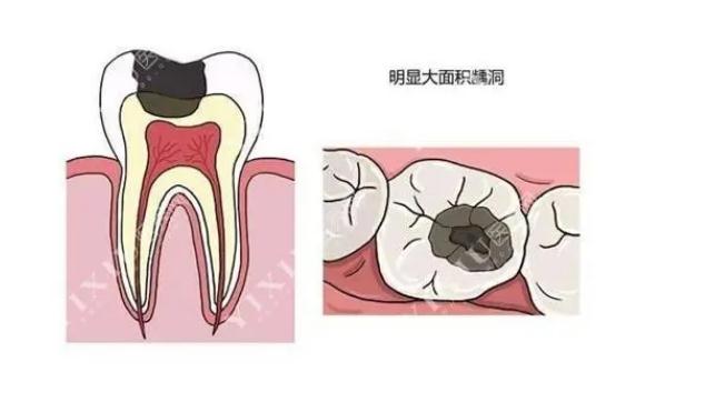 牙齒有洞不補會怎樣？牙齒有洞為什么一定要補？