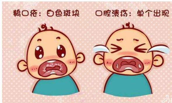 如何區(qū)別鵝口瘡和口腔潰瘍？鵝口瘡有什么癥狀？