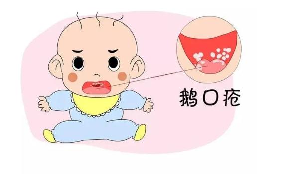 鵝口瘡是怎么引起的？寶寶得鵝口瘡怎么護(hù)理？