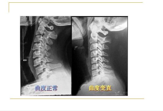 頸椎病能引起后背疼嗎？頸椎病的鑒別診斷有哪些？