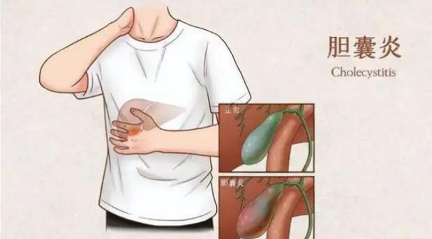 膽囊炎都有何危害呢？結(jié)石和寄生蟲能引起膽囊炎嗎？