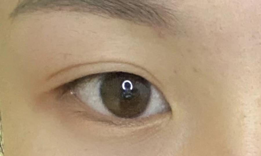 傳統(tǒng)全切雙眼皮和王海木瞼緣切口怎么選？