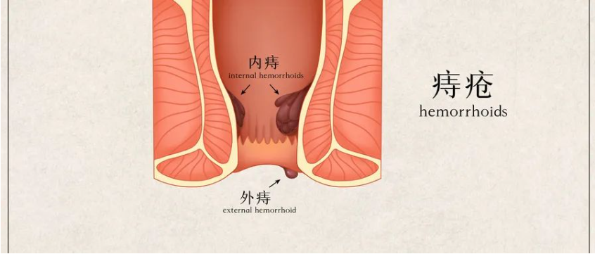 【北京豐益肛腸醫(yī)院】痔瘡久拖不治非良策，長期便血容易引發(fā)貧血