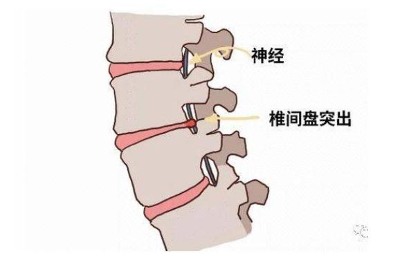 腰間盤突出吃什么藥？腰間盤突出能治愈嗎？