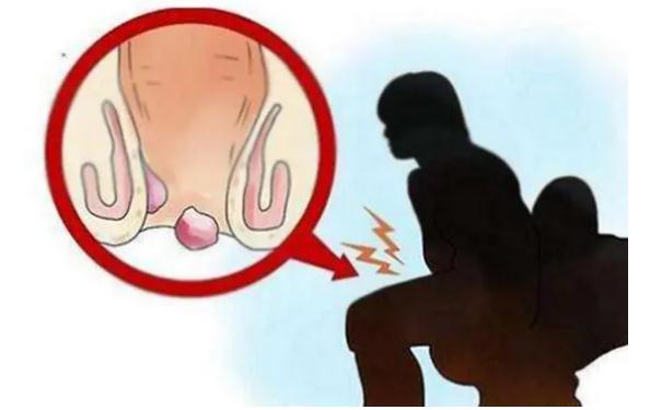 什么原因讓我們患上痔瘡？痔瘡患者有哪些東西不能吃？