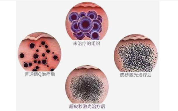 激光美容祛斑后的效果怎么樣？激光美容祛斑后可維持多久時間？