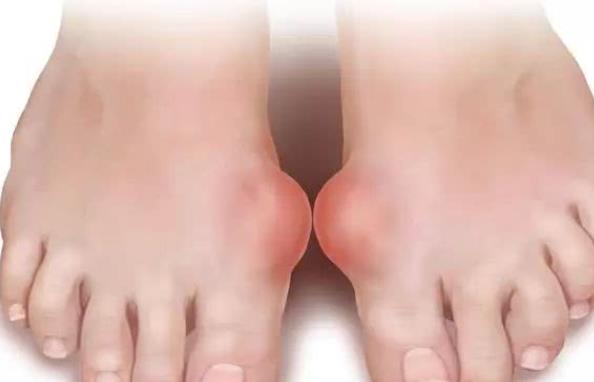 尿酸高掛什么科治療 怎么預防尿酸高