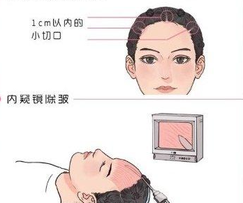 王海木內(nèi)窺鏡拉皮除皺術(shù)可以用于哪些部位？