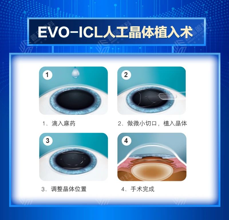  ICL晶體植入術(shù)-近視患者的多重選擇|天津普瑞眼科提示您：術(shù)前先讀懂這些！