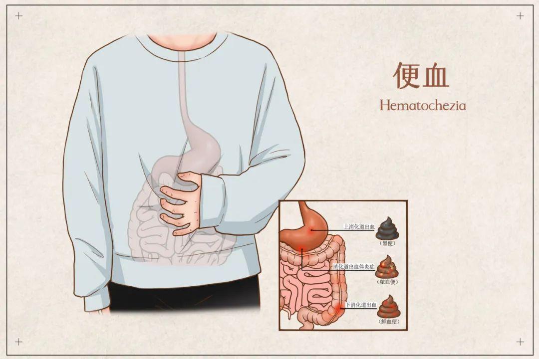 包頭東大肛腸?？漆t(yī)院詳解大便出血是怎么回事？