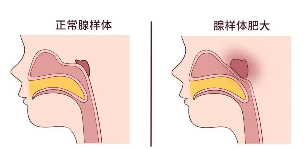 為什么現(xiàn)在患腺樣體肥大的孩子越來越多？聽聽成都民生耳鼻喉醫(yī)院怎么說