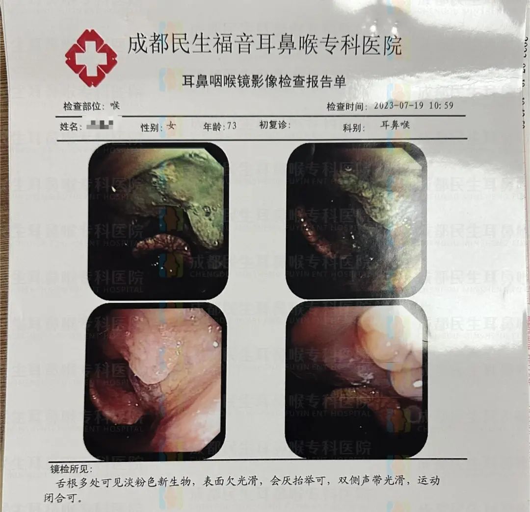 吞咽異物感讓她寢食難安，到成都民生耳鼻喉醫(yī)院一查，還查出另一種癌……