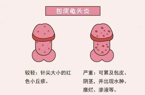 綿陽(yáng)高水醫(yī)院治療價(jià)格高不高？丁丁頭發(fā)紅？丁丁頭有小紅點(diǎn)？怎么辦？