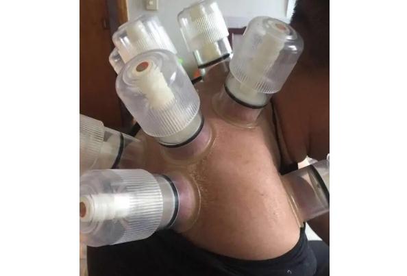 肩周炎是怎么引起的？肩周炎可以拔火罐嗎？