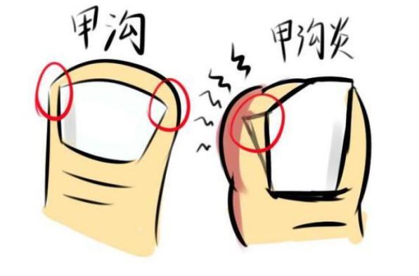 甲溝炎不拔指甲會(huì)好嗎？甲溝炎要拔掉整個(gè)指甲嗎？