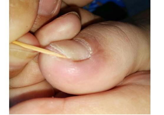 甲溝炎指甲長肉里好深怎么辦？甲溝炎拔甲后會復(fù)發(fā)嗎？