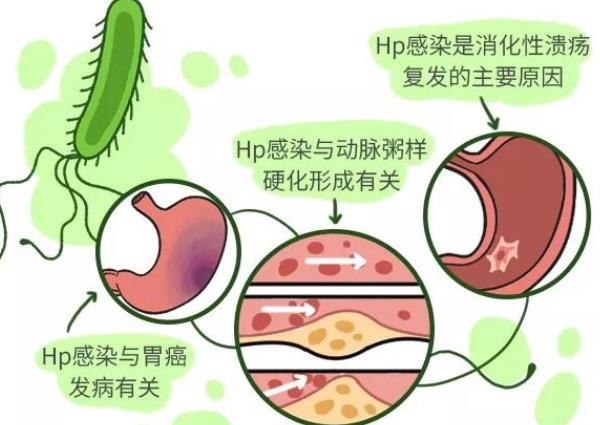 幽門(mén)螺桿菌會(huì)傳染給小孩嗎 幽門(mén)螺桿菌如何傳染給小孩